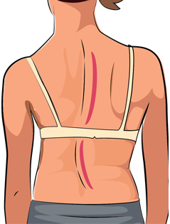 Scoliosis Assessment