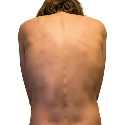 is scoliosis genetic