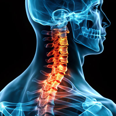 Loss of Cervical Lordosis